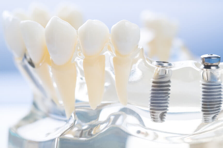 インプラント治療と入れ歯治療の違いは？